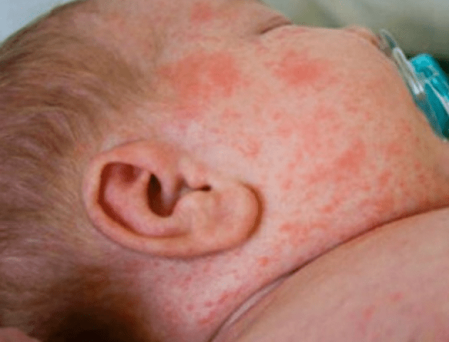У Нововолинську – перший випадок кору: захворіла 10-місячна дитина
