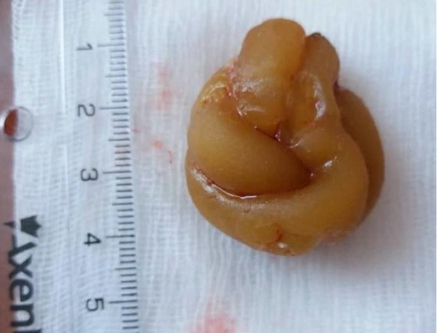 Неймовірне реальне: у сечовому міхурі волинянина лікарі знайшли воскову свічку. ФОТО