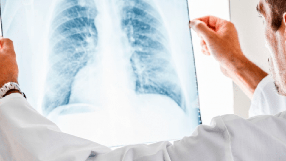 Назвали найпоширеніші міфи про туберкульоз