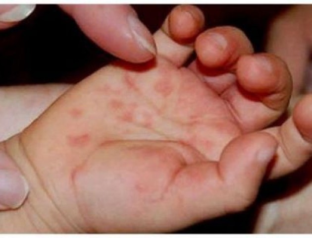 Спалах ентеровірусу: захворіло 73 дитини