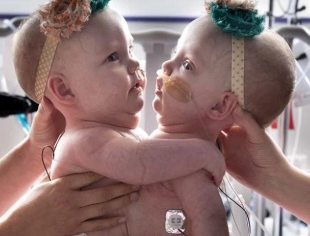 Життя сіамських близнюків після поділу: неймовірні фото